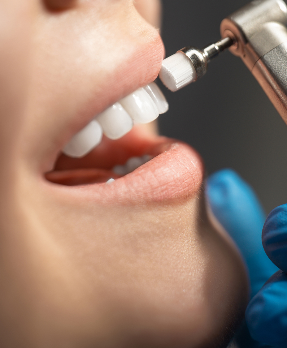 Veneers Charleston, SC Hilton Head Porcelain Veneers by Dr. Rink