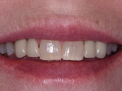 Bridges Before & After Gallery - Patient 4882670 - Image 1