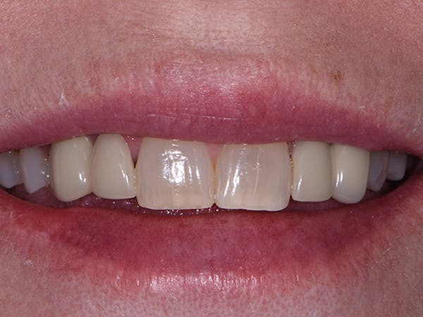 Bridges Before & After Gallery - Patient 4882670 - Image 1