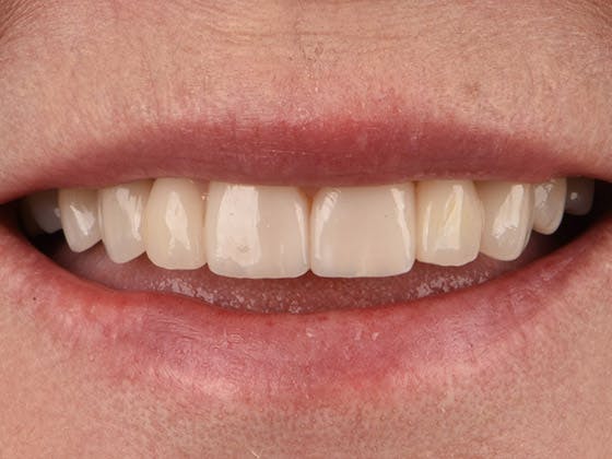 Bridges Before & After Gallery - Patient 4882670 - Image 2