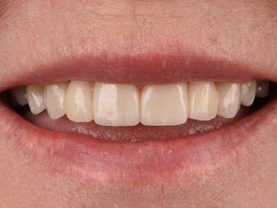 Bridges Before & After Gallery - Patient 4882670 - Image 2