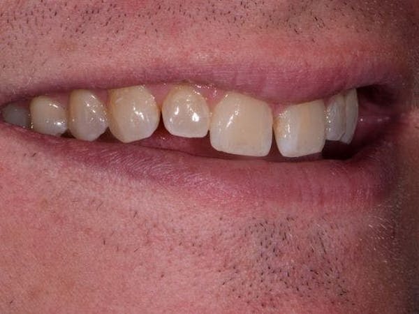 Porcelain Veneers Before & After Gallery - Patient 4882920 - Image 3