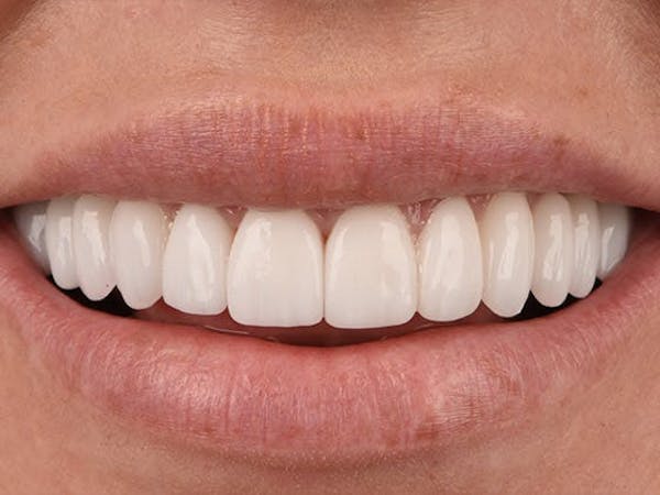 Full Mouth Reconstruction Before & After Gallery - Patient 4891094 - Image 2