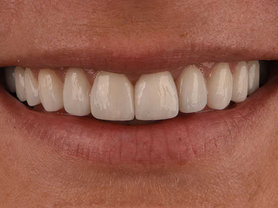 Before & After Prepless Veneers