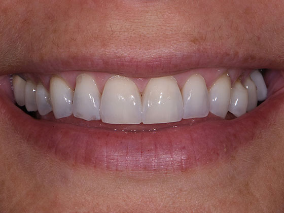 Before & After Prepless Veneers