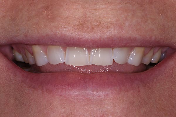 Full Mouth Reconstruction Before & After Gallery - Patient 7316549 - Image 1