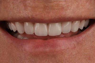 Full Mouth Reconstruction Before & After Gallery - Patient 7316549 - Image 2