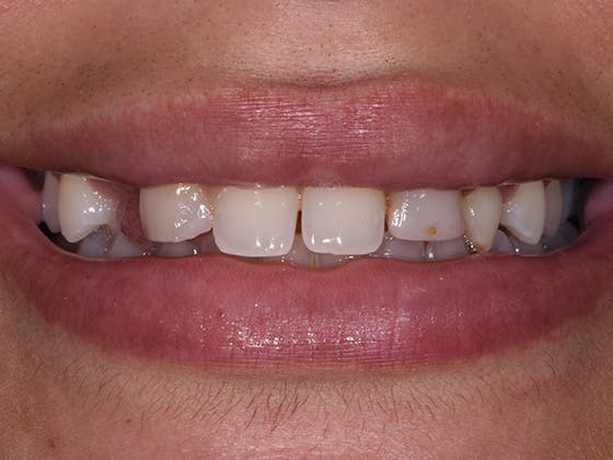 Bridges Before & After Gallery - Patient 7574238 - Image 1