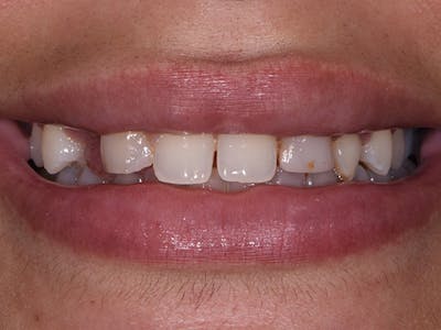 Bridges Before & After Gallery - Patient 7574238 - Image 1