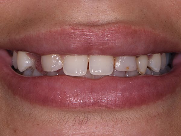 Bridges Before & After Gallery - Patient 7574238 - Image 1