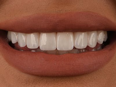 Bridges Before & After Gallery - Patient 7574238 - Image 2
