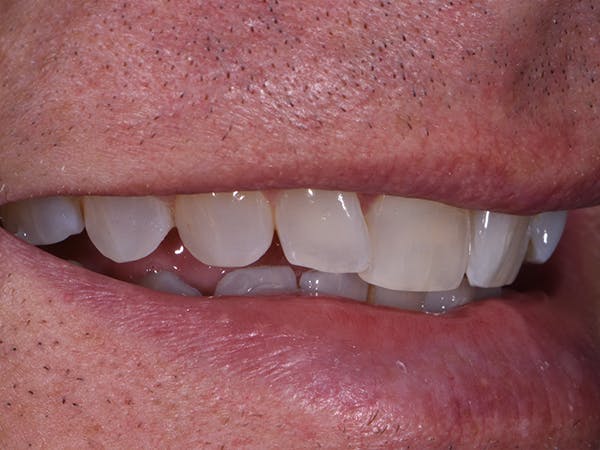 Tooth photo