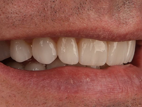 Tooth photo
