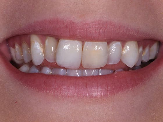 Porcelain Crowns Before & After Gallery - Patient 39208968 - Image 1