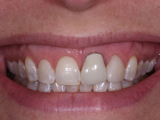 Dental Implants Before & After Gallery - Patient 39217589 - Image 1