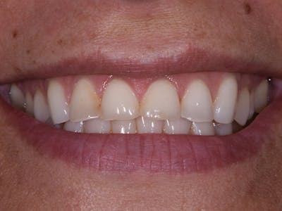 Porcelain Crowns Before & After Gallery - Patient 39217614 - Image 1