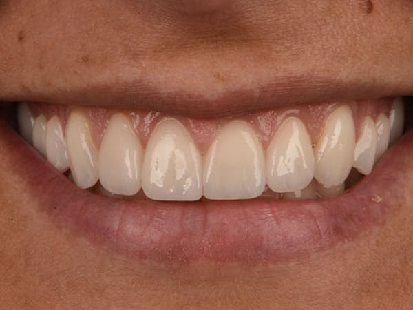 Porcelain Crowns Before & After Gallery - Patient 39217614 - Image 2