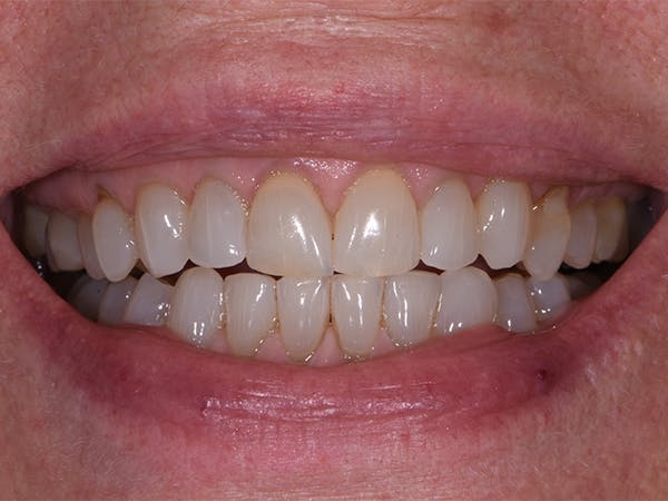 Before & After Teeth Whitening