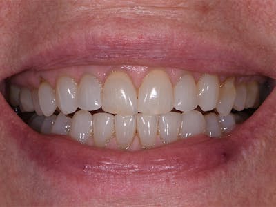 Teeth Whitening Before & After Gallery - Patient 39976996 - Image 1
