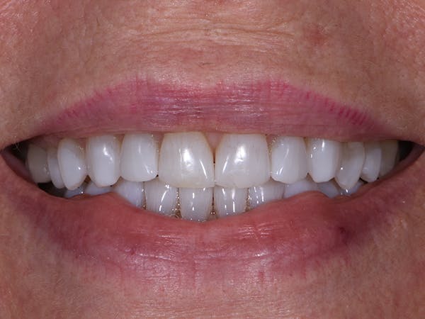 Before & After Teeth Whitening