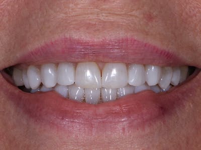 Teeth Whitening Before & After Gallery - Patient 39976996 - Image 2
