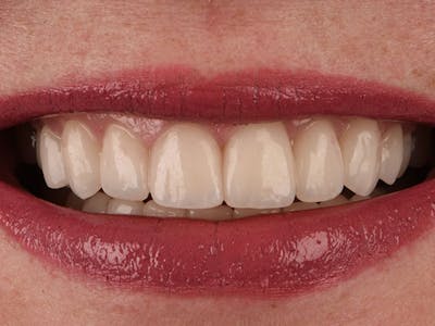 Tooth photo