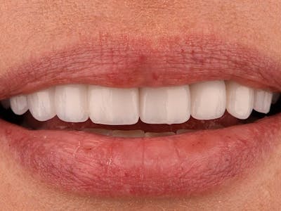 Bridges Before & After Gallery - Patient 3014733 - Image 2