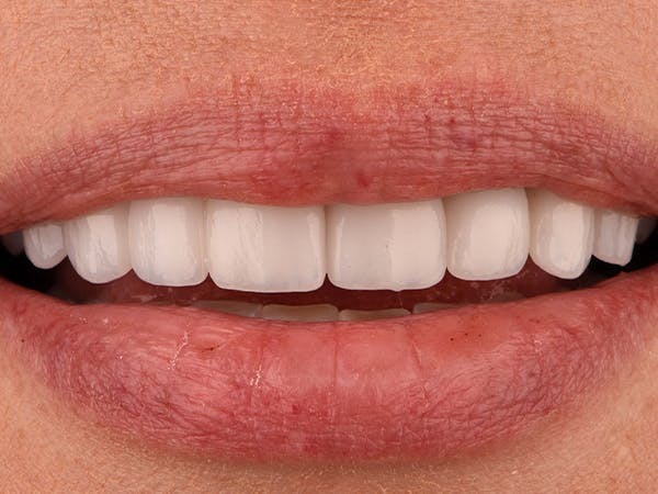 Bridges Before & After Gallery - Patient 3014733 - Image 2