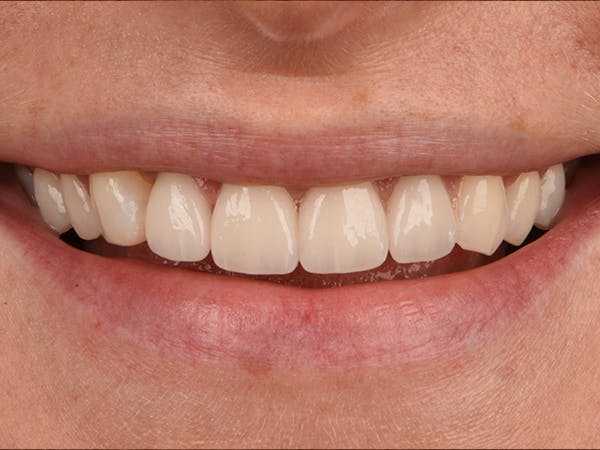 Tooth photo
