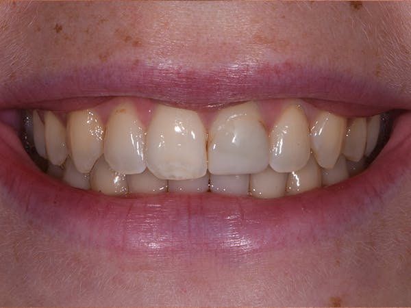 Porcelain Crowns Before & After Gallery - Patient 74763796 - Image 1