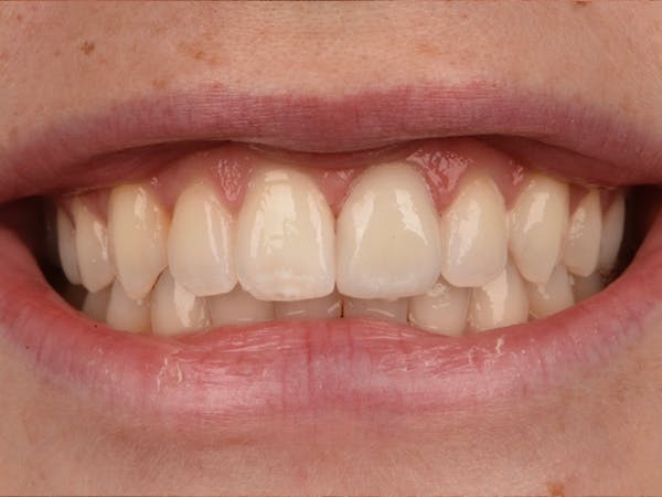 Porcelain Crowns Before & After Gallery - Patient 74763796 - Image 2