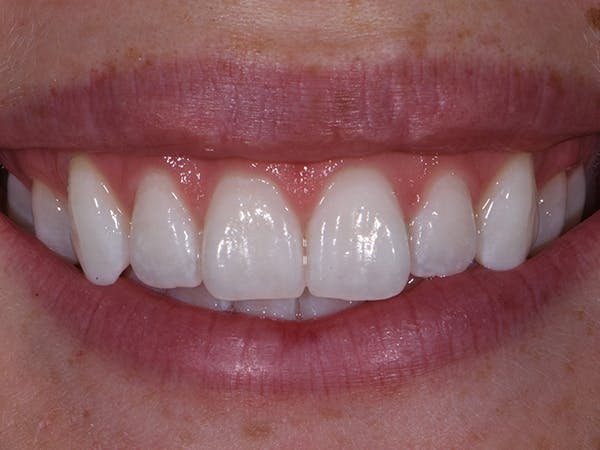 Teeth Whitening Before & After Gallery - Patient 74765297 - Image 2