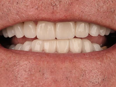 Full Mouth Reconstruction Gallery - Patient 140400199 - Image 2