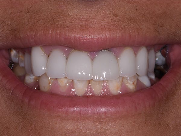 Full Mouth Reconstruction Before & After Gallery - Patient 140400198 - Image 1