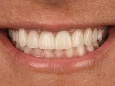 Full Mouth Reconstruction Gallery - Patient 140400198 - Image 2