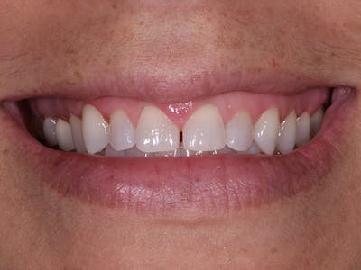 Tooth photo