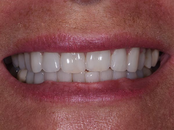 Tooth photo