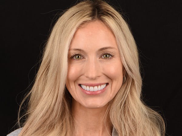 Porcelain Veneers Before & After Gallery - Patient 140400262 - Image 4