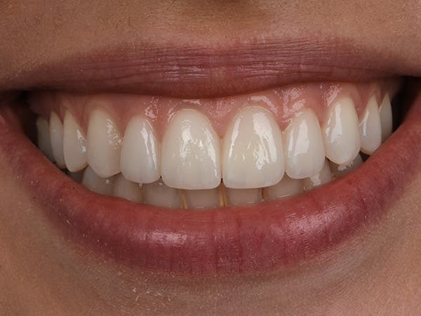 Porcelain Veneers Before & After Gallery - Patient 140400261 - Image 2
