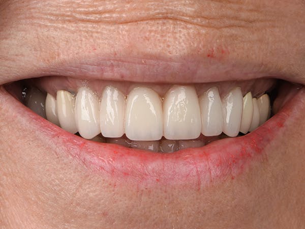 Porcelain Veneers Before & After Gallery - Patient 140400260 - Image 2