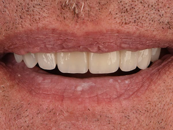 Porcelain Veneers Before & After Gallery - Patient 140400259 - Image 2