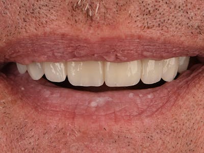 Porcelain Veneers Before & After Gallery - Patient 140400259 - Image 2
