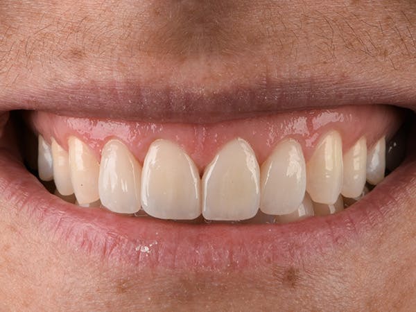 Porcelain Veneers Before & After Gallery - Patient 140400257 - Image 2