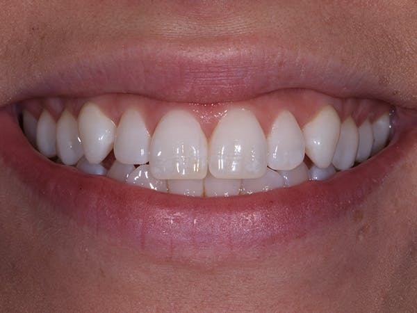 Porcelain Veneers Before & After Gallery - Patient 140400256 - Image 1