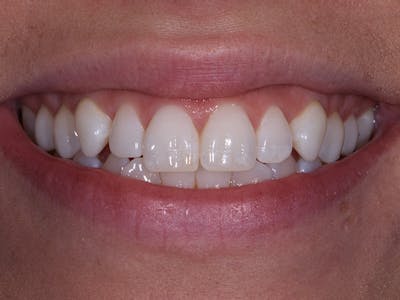 Porcelain Veneers Before & After Gallery - Patient 140400256 - Image 1