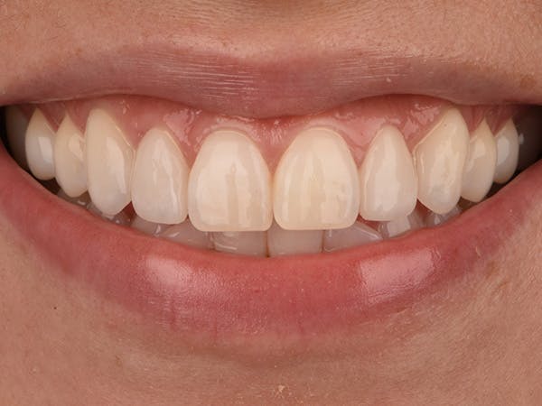 Porcelain Veneers Before & After Gallery - Patient 140400256 - Image 2