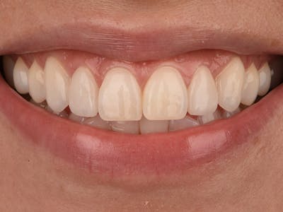 Porcelain Veneers Before & After Gallery - Patient 140400256 - Image 2
