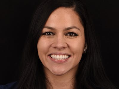Porcelain Veneers Before & After Gallery - Patient 140400256 - Image 4