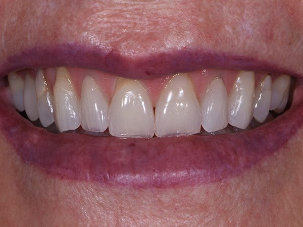 Porcelain Veneers Before & After Gallery - Patient 140400254 - Image 1
