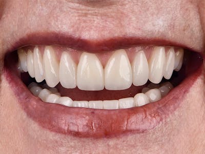 Porcelain Veneers Before & After Gallery - Patient 140400254 - Image 2